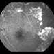 Sickle Cell Retinopathy with Sea Fans (angiogram) Sickle Cell Retinopathy with Sea Fans (angiogram)